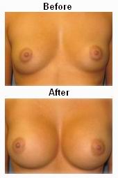 Breast augmentation procedure illustration