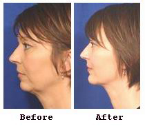 Face lift surgical technique diagram showing incision placement
