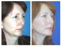 Post-operative face lift results showing healing progression