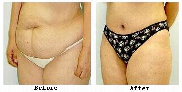 Abdominoplasty incision placement and technique illustration