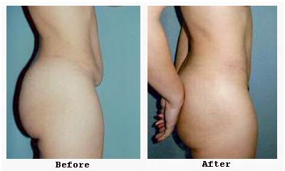 Person showing toned abdomen after tummy tuck surgery