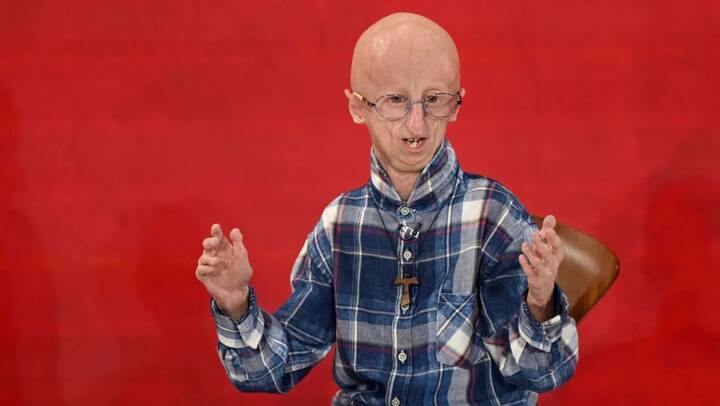 Understanding Progeria (Hutchinson-Gilford Syndrome): Causes, Symptoms ...