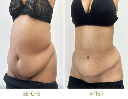 Abdominoplasty (Tummy Tuck) | Causes, Symptoms & Treatment Guide