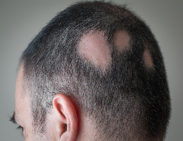 Alopecia (Hair Loss) | Causes, Symptoms & Treatment Guide