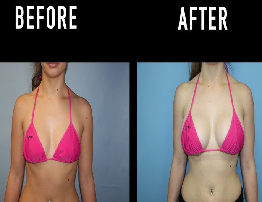 Breast Augmentation | Causes, Symptoms & Treatment Guide