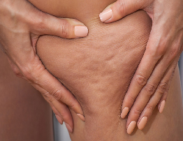 Cellulite | Causes, Symptoms & Treatment Guide