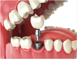 Dental Implants | Causes, Symptoms & Treatment Guide