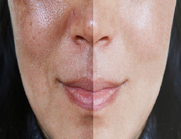 Hyperpigmentation | Causes, Symptoms & Treatment Guide