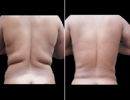 Liposuction | Causes, Symptoms & Treatment Guide