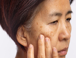 Melasma | Causes, Symptoms & Treatment Guide