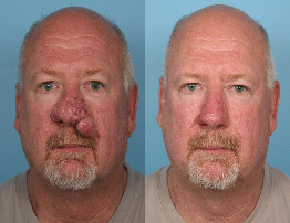 Rhinophyma | Causes, Symptoms & Treatment Guide