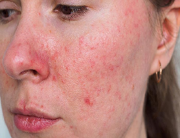 Rosacea | Causes, Symptoms & Treatment Guide