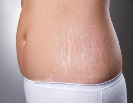 Stretch Marks (Striae) | Causes, Symptoms & Treatment Guide
