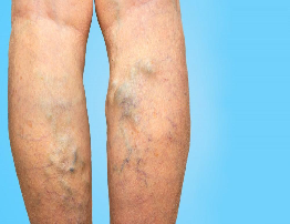 Varicose Veins | Causes, Symptoms & Treatment Guide